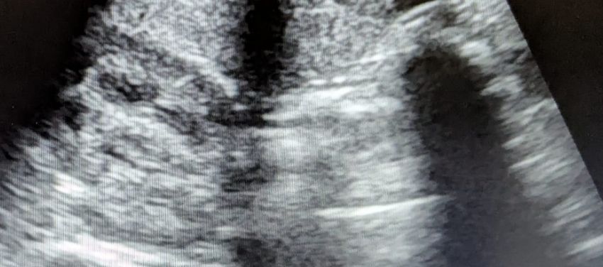 Ultraschallbild
